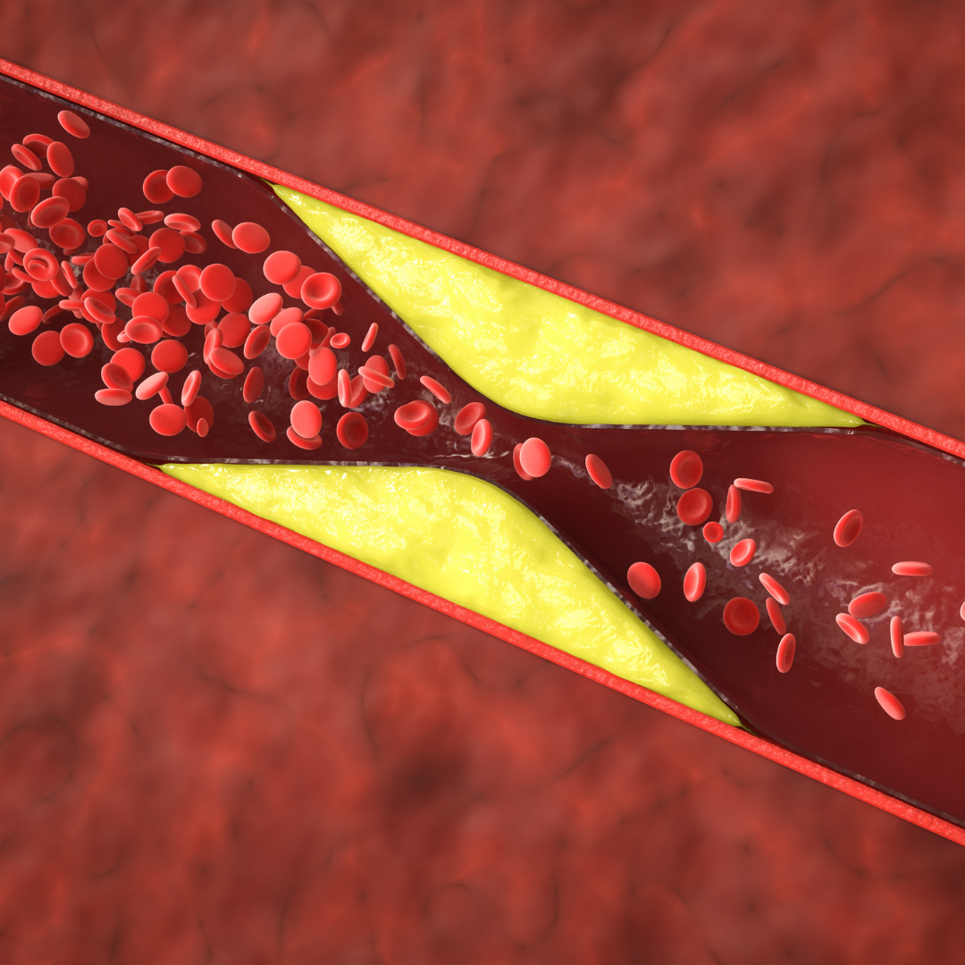 image depicting plaque buildup in an artery as part of atherosclerosis